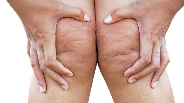 lipodem kadinlarin sessiz cigligi neden kilo veremiyorum diyenler icin cevap kZLr26lW.jpg